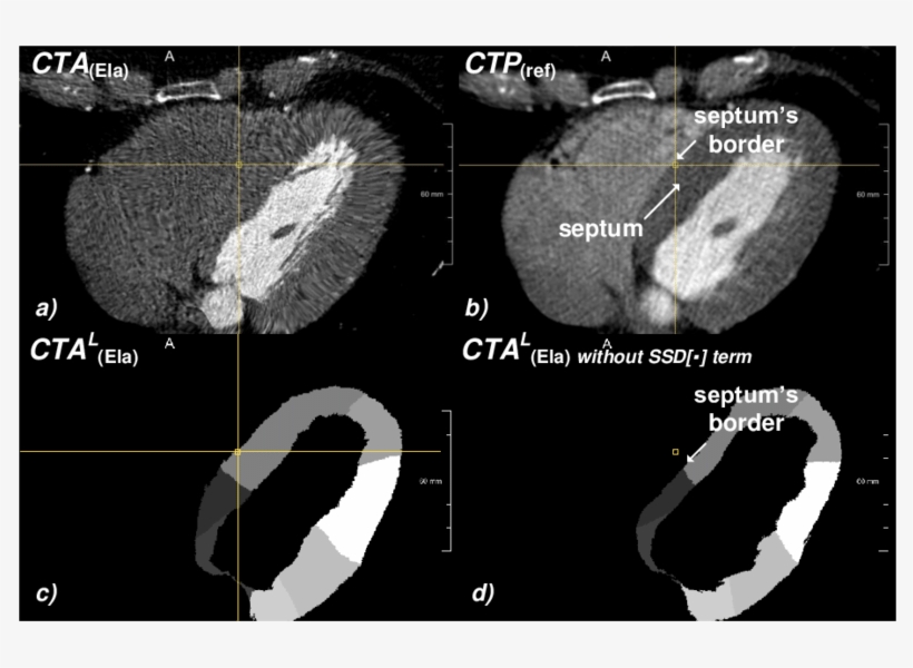 A) Registered Image Ct A (ela) Obtained With The Ssd[·] - Computed Tomography, transparent png
