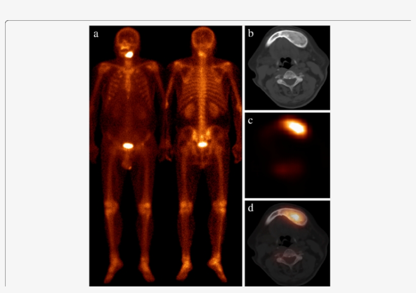 Patient 1 Presented With Newly Diagnosed Lung Cancer - Darkness, transparent png