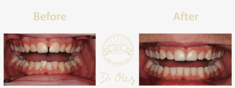 425 Before After Invisaline22 - Portable Network Graphics, transparent png