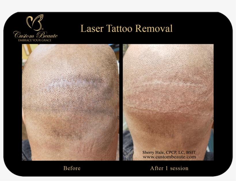 Video Player - Embrace Scar Before And After, transparent png
