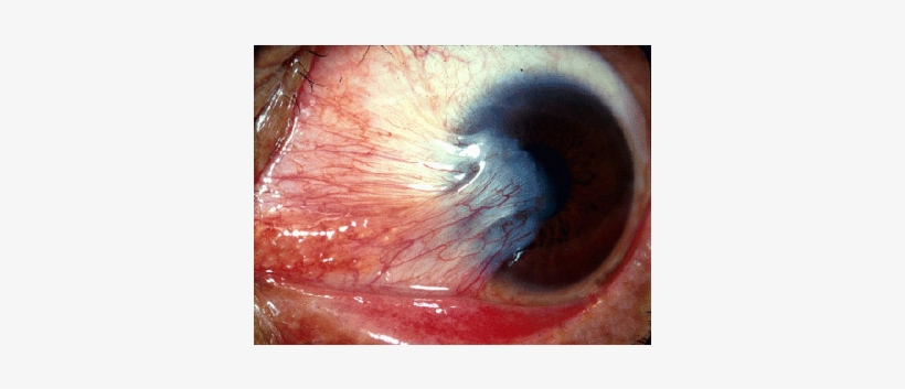 Eyes Pterygium - Ocular Rosacea Eye, transparent png