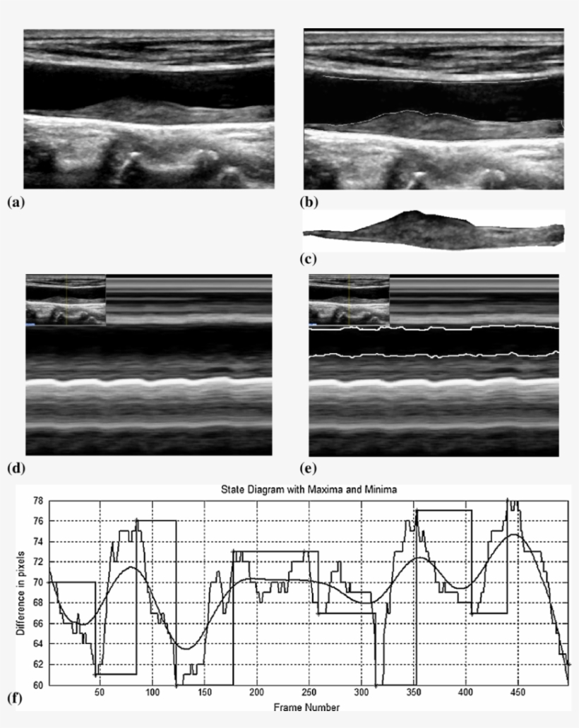 Illustration Of The M-mode Procedure - Monochrome, transparent png