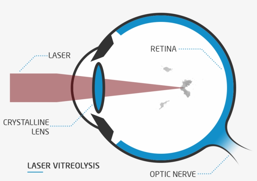 What Is Laser Vitreolysis - Presbiopia Png, transparent png