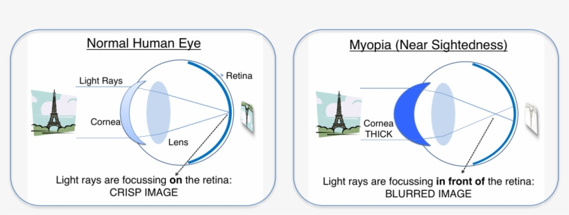 Lasik Surgery In Delhi - Eifelturm Grafik, transparent png