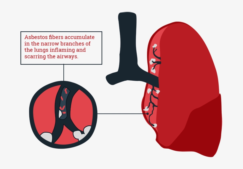 Asbestosis And Asbestos Exposure - Asbestosis Png, transparent png