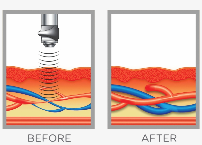 Swiss Wave Therapy Demo11 - Stl Medical Solutions St. Louis' Premier Men's Clinic, transparent png
