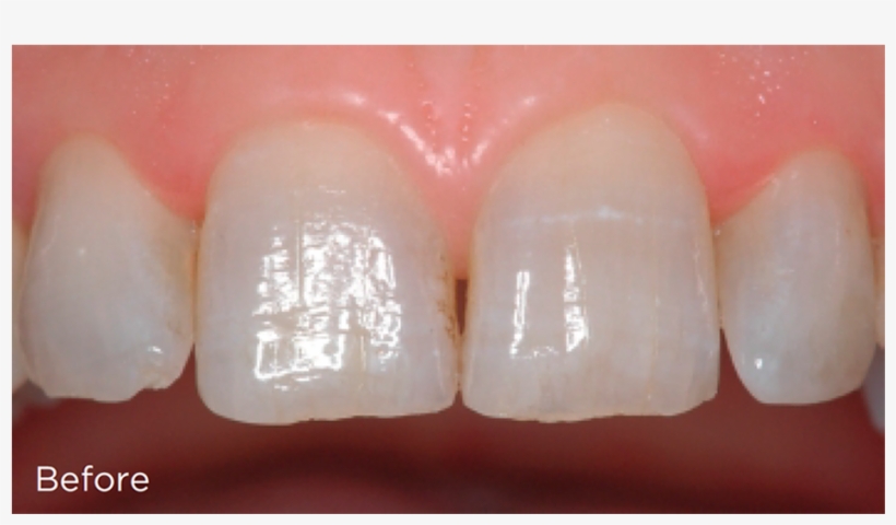 Before Veneers - Composite Material, transparent png