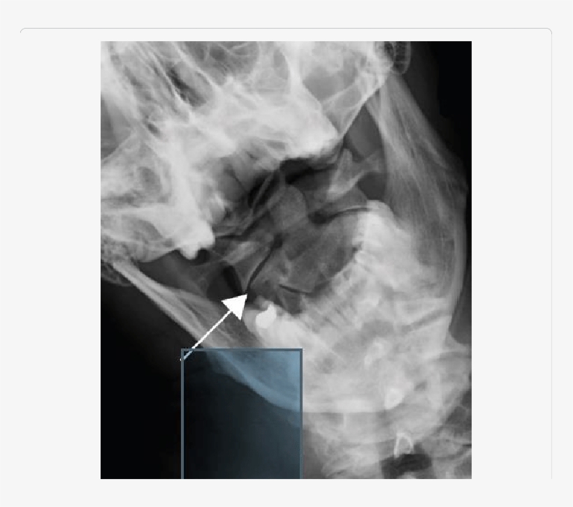 Ap Open Mouth Radiograph Of The C1 C2 Levels Showing - Radiography, transparent png