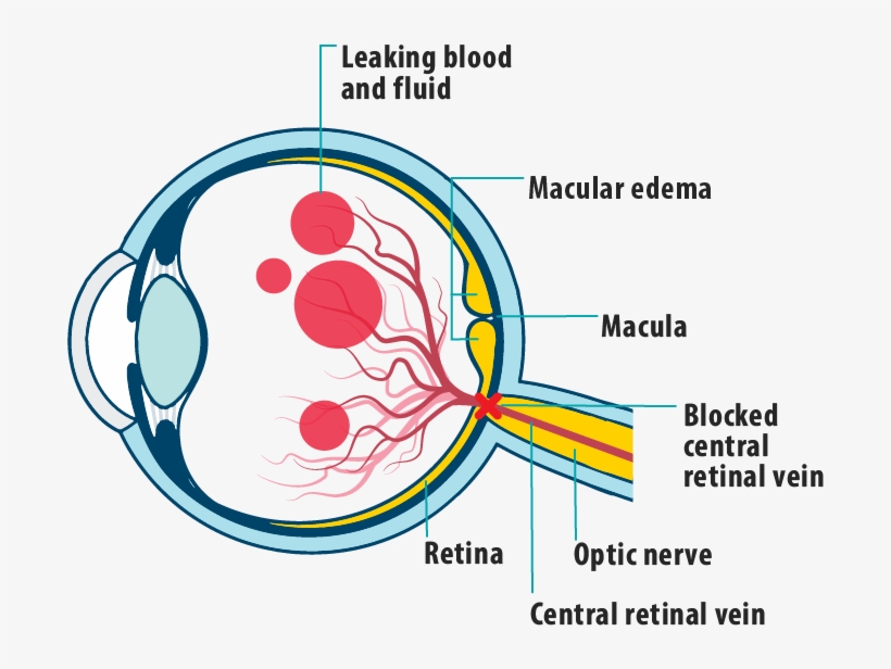 Picture Of Effects Of Mefcrvo On The Eye, Showing Leaking - Macula Of Retina, transparent png