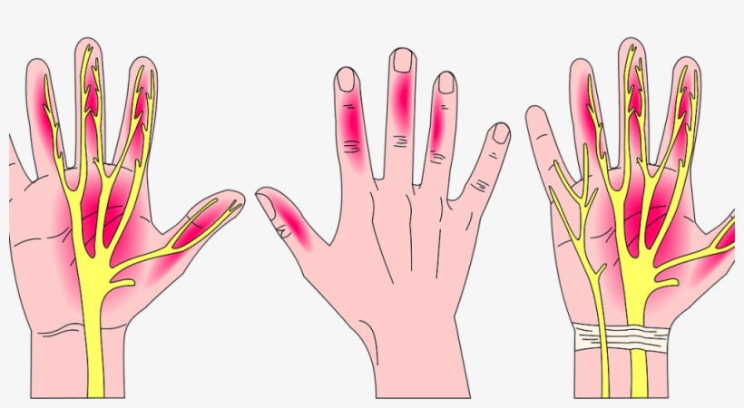 Carpal Tunnel Syndrome Painting, transparent png
