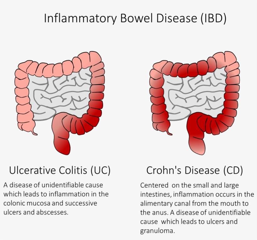 Figure 1) Ibd Is A Group Of Diseases Which Cause Inflammation - Inflammatory Bowel Disease Adalah, transparent png
