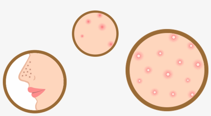 Acne, transparent png