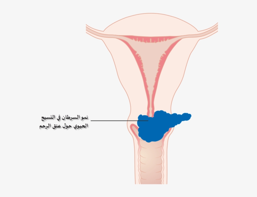 Diagram Showing Stage 2b Cervical Cancer Cruk 216-ar - Cervical Cancer, transparent png