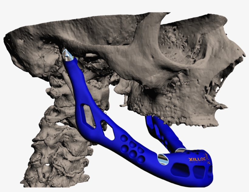 A Lower Jaw Made Of Titanium And Ceramic - Additive Manufacturing In Medical Implants, transparent png
