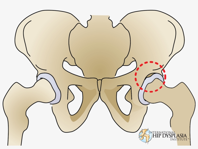 [ ] Enlarge - Hip Dysplasia Torn Labrum, transparent png