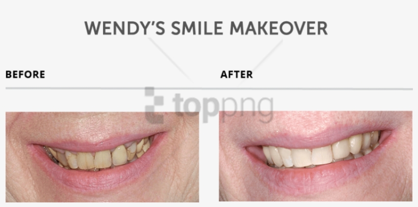 Free Png Download Teeth Makeover Png Images Background - Teeth Makeover, transparent png