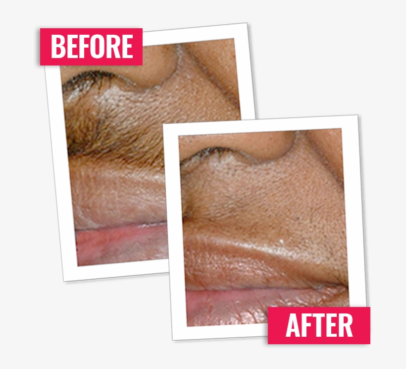 I'm Incredibly Pleased With This Product I Have Two - Beard Removal Cream For Face, transparent png