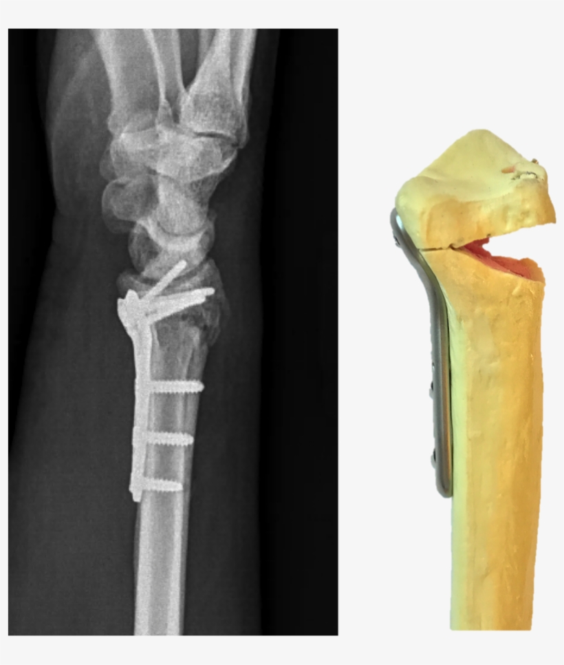 Lateral X-ray Of A Distal Radius Fracture Treated With - Wrist Plate And Screws, transparent png
