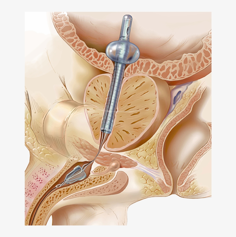 Greatly Preferred By Patients Over Catheterization - Catheter Alternative, transparent png