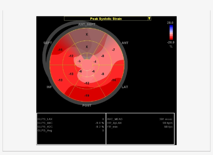 Bull's Eye " View Of The Longitudinal 2d Strain Of - Circle, transparent png