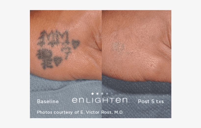 Tattoo Removal* - Tattoo, transparent png