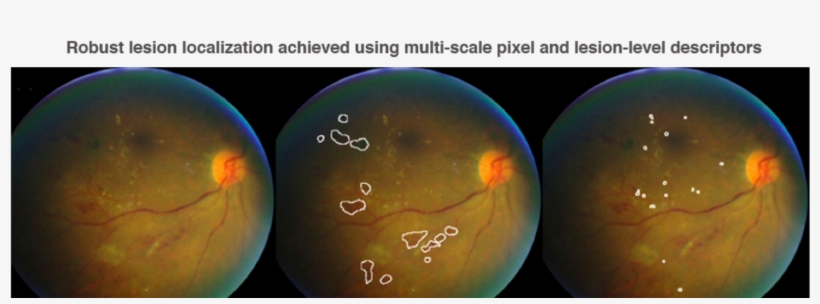 Deep Learning In Ophthalmology How Google Did It - Earth, transparent png