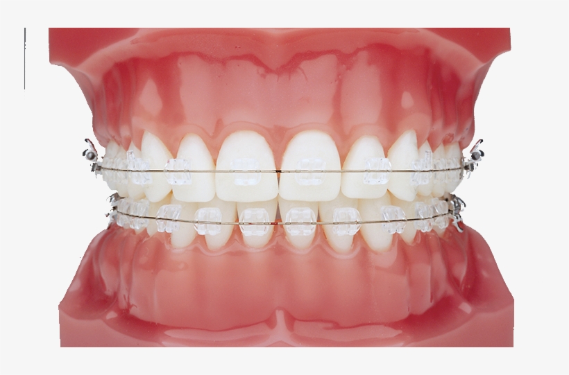Ceramic Braces - Imágenes De Frenos Dentales, transparent png