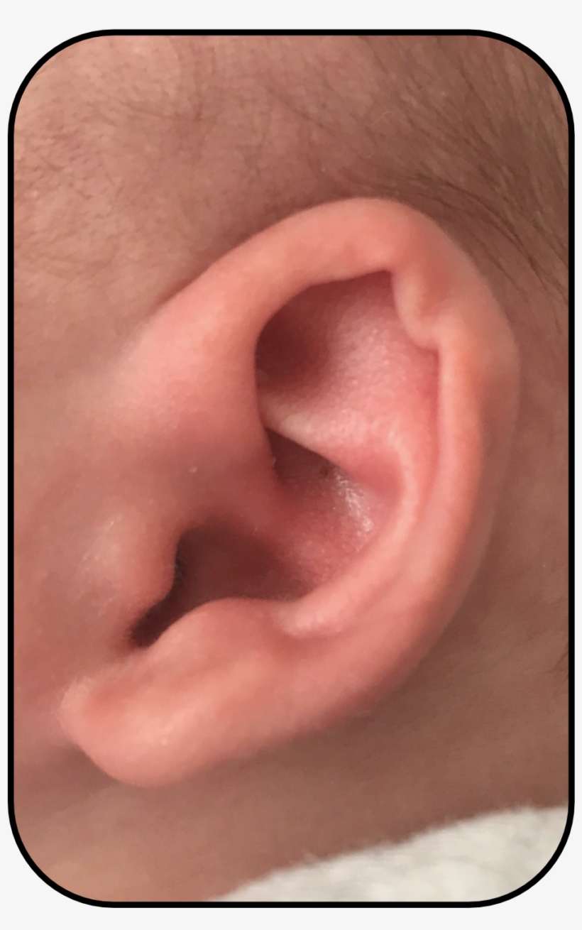Corrected Baby Ear Usa Parent Story, transparent png