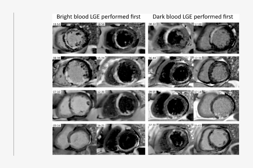Examples Of 4 Patients That Underwent Bright Blood - Circle, transparent png