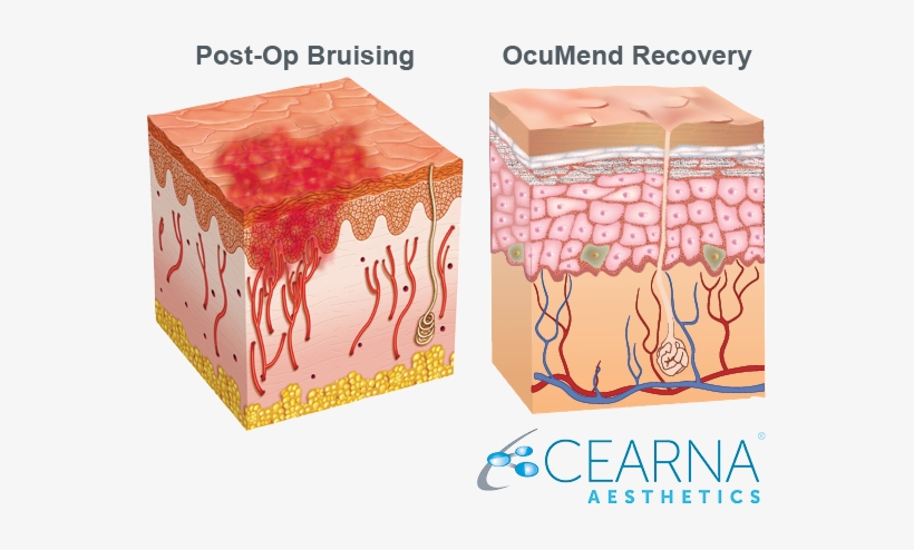 The Only Patented Bruising And Swelling Solution Backed - Skin, transparent png