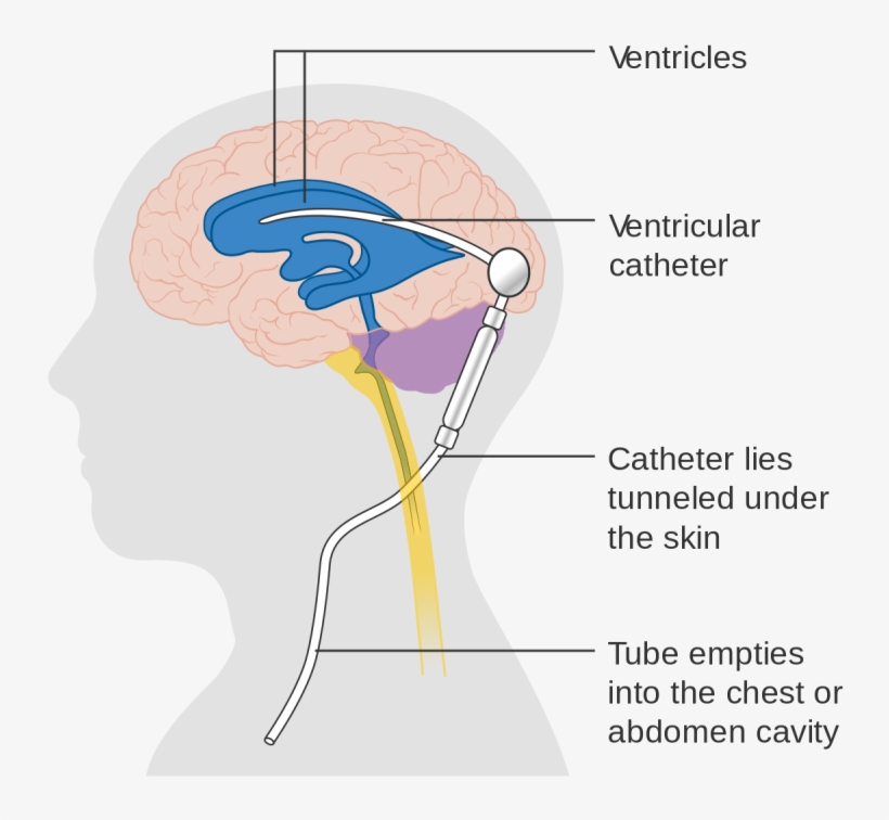 Diagram Showing A Brain Shunt Cruk - Program Valve Shunt, transparent png