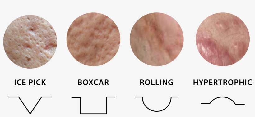 Airjet Acne Scar Treatment Shiro Aesthetic Cinic - Mettwurst, transparent png