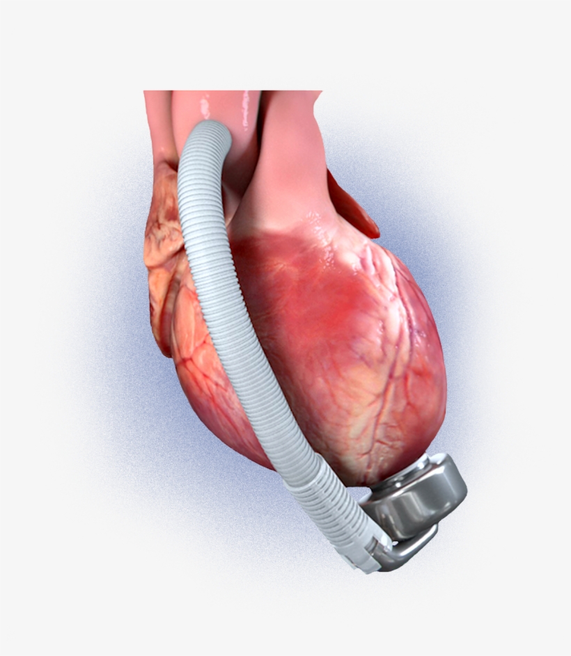 A Standard Implantation Procedure - Injury, transparent png