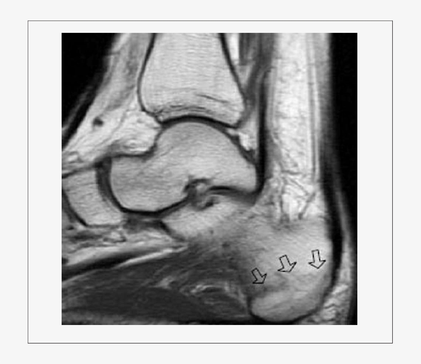 Radiograph Before Shock Wave Therapy - X-ray, transparent png