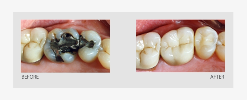 Most Often Complete Your Crown In One Visit With A - Filling Removal, transparent png