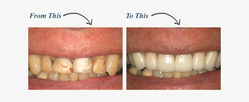 Crowns - Much Do Dental Crowns Cost, transparent png