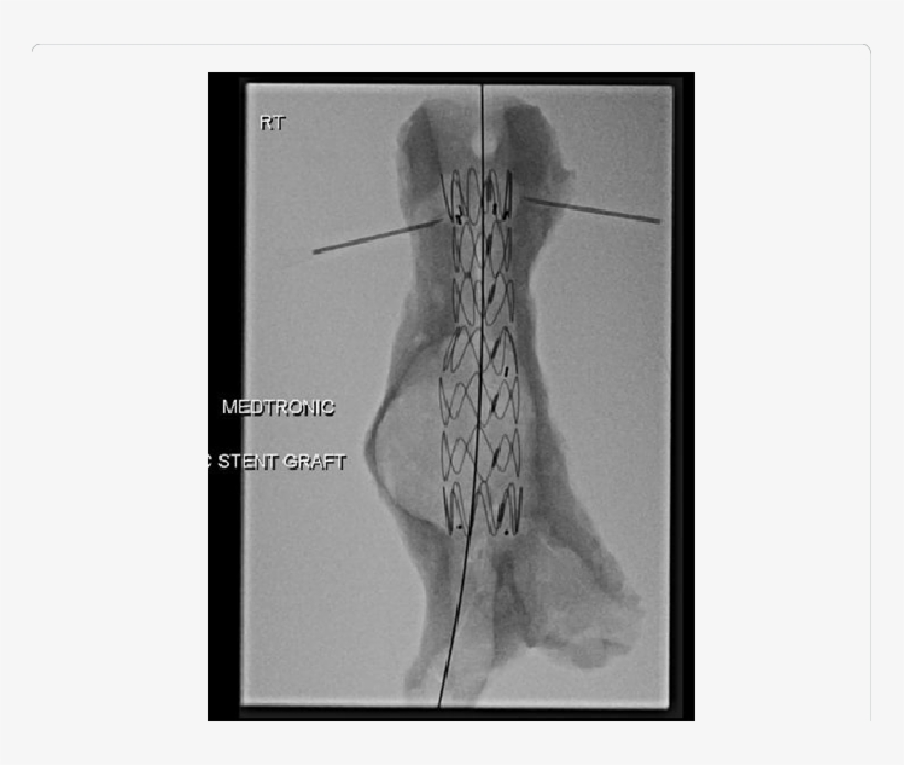 Preoperative Simulation Of Evar On An Aaa Shell - Rib, transparent png
