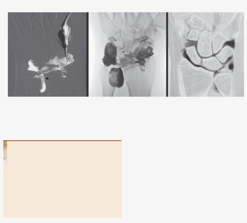 Triangular Fibrocartilage Tear Syndrome - Visual Arts, transparent png