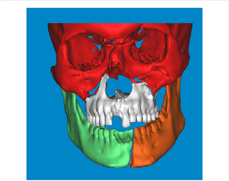 D Cad Model Of The Patient - Computer-aided Design (761x602), Png Download