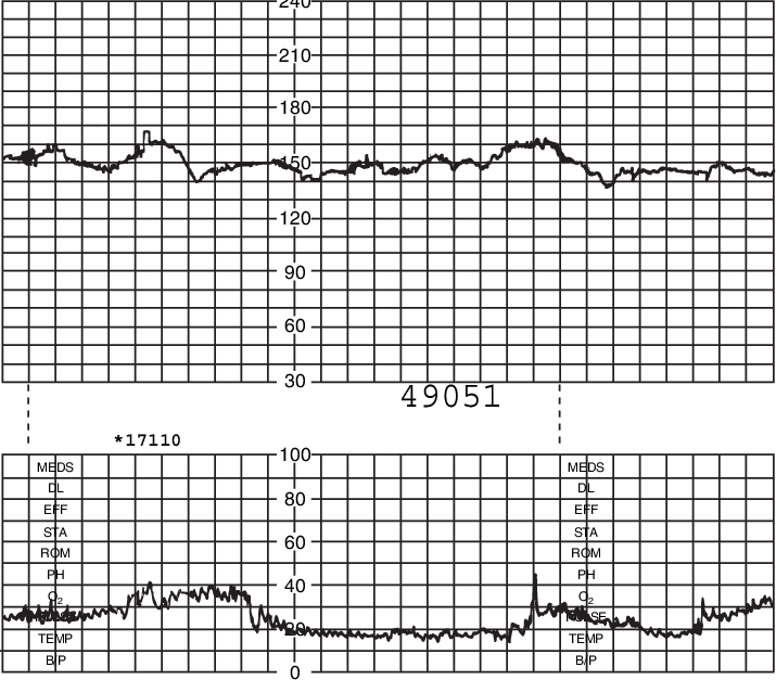Normal Fetal Heart Rate Pattern - Monacor Airmt-85 Air Motion Transformers - Miscellaneous (715x627), Png Download