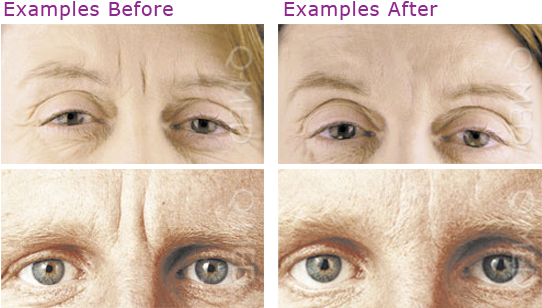 Botox New - Botox Before And After (553x316), Png Download