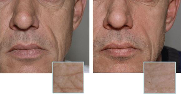 Anti Wrinkle Brisbane - Wrinkle (580x301), Png Download