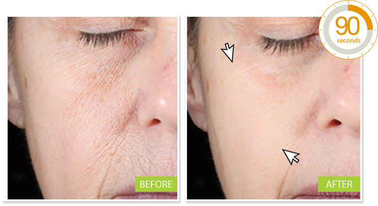 Neutratone Introductory Anti-aging Regimen Miracle - Eye Wrinkle Filler (742x404), Png Download