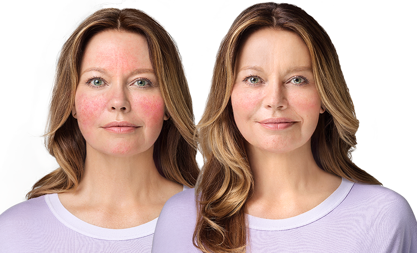 For Persistent Facial Erythema Associated With Rosacea - Before And After Ad (832x505), Png Download