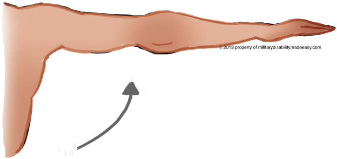 Shoulder Muscle 6 - Arm Atrophy (683x322), Png Download