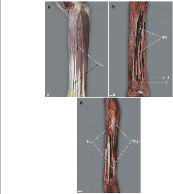 Palmaris Longus Muscle (850x762), Png Download