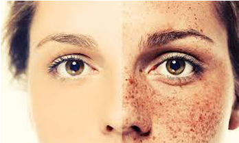 Freckles Are Skin Cells That Contain A Pigment Called - Yüzdeki Çiller Nasıl Geçer (669x285), Png Download