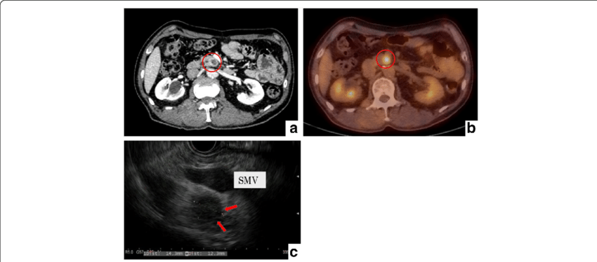 Radiological And Endoscopic Ultrasonographic Findings - Computed Tomography (850x374), Png Download