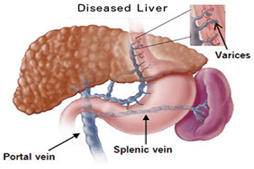 Gastroesophageal Varices Icd 10 (520x245), Png Download