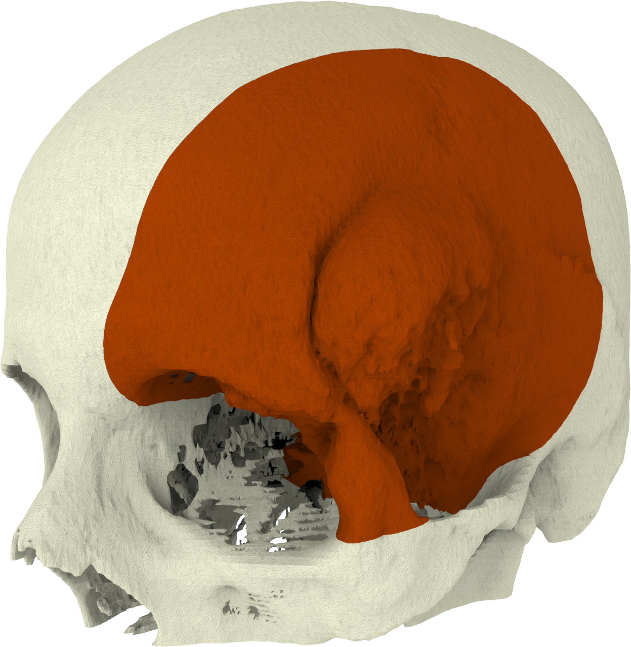 Together With The Surgeon Our Biomedical Engineers - Meningioma (1247x1278), Png Download